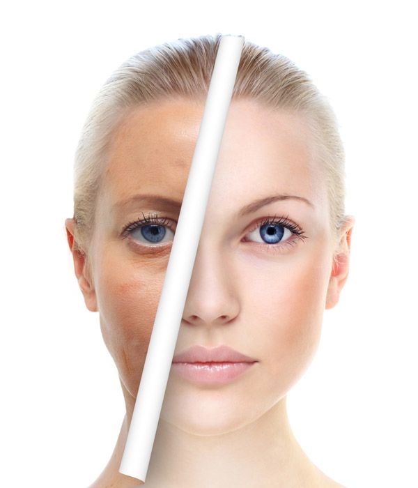 What are some of the side effects of using Fotofacial RF?